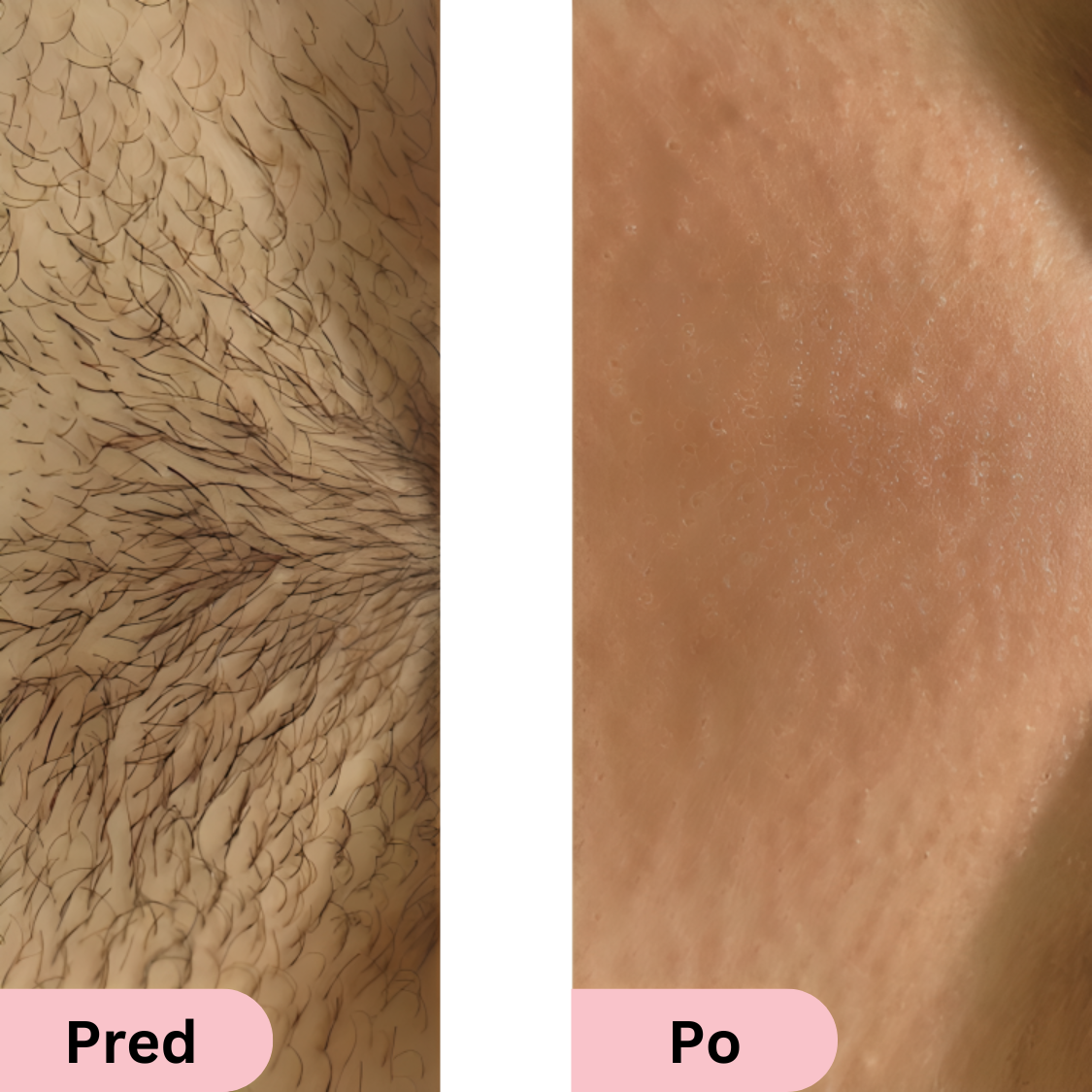 Glowie™ IPL epilátor – Zariadenie na odstránenie chĺpkov