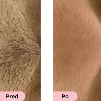 Glowie™ IPL epilátor – Zariadenie na odstránenie chĺpkov