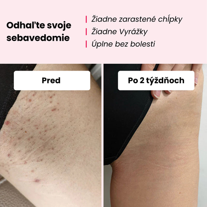 Glowie™ sada na odstraňovanie chĺpkov